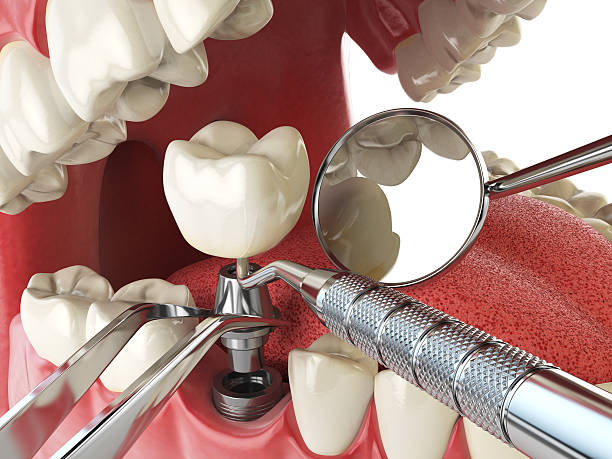 Best Emergency Tooth Extraction  in Clancy, MT